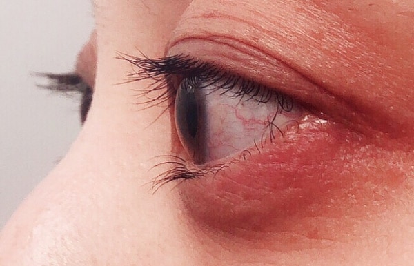 目 の 腫れ アレルギー 29.アレルギーによる目の病気｜目と健康シリーズ｜三和化学研究所