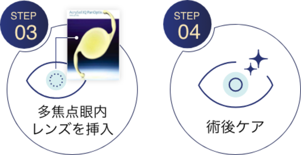 多焦点眼内レンズを用いた水晶体再建手術