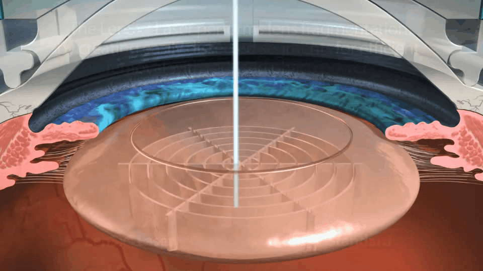 レーザー手術