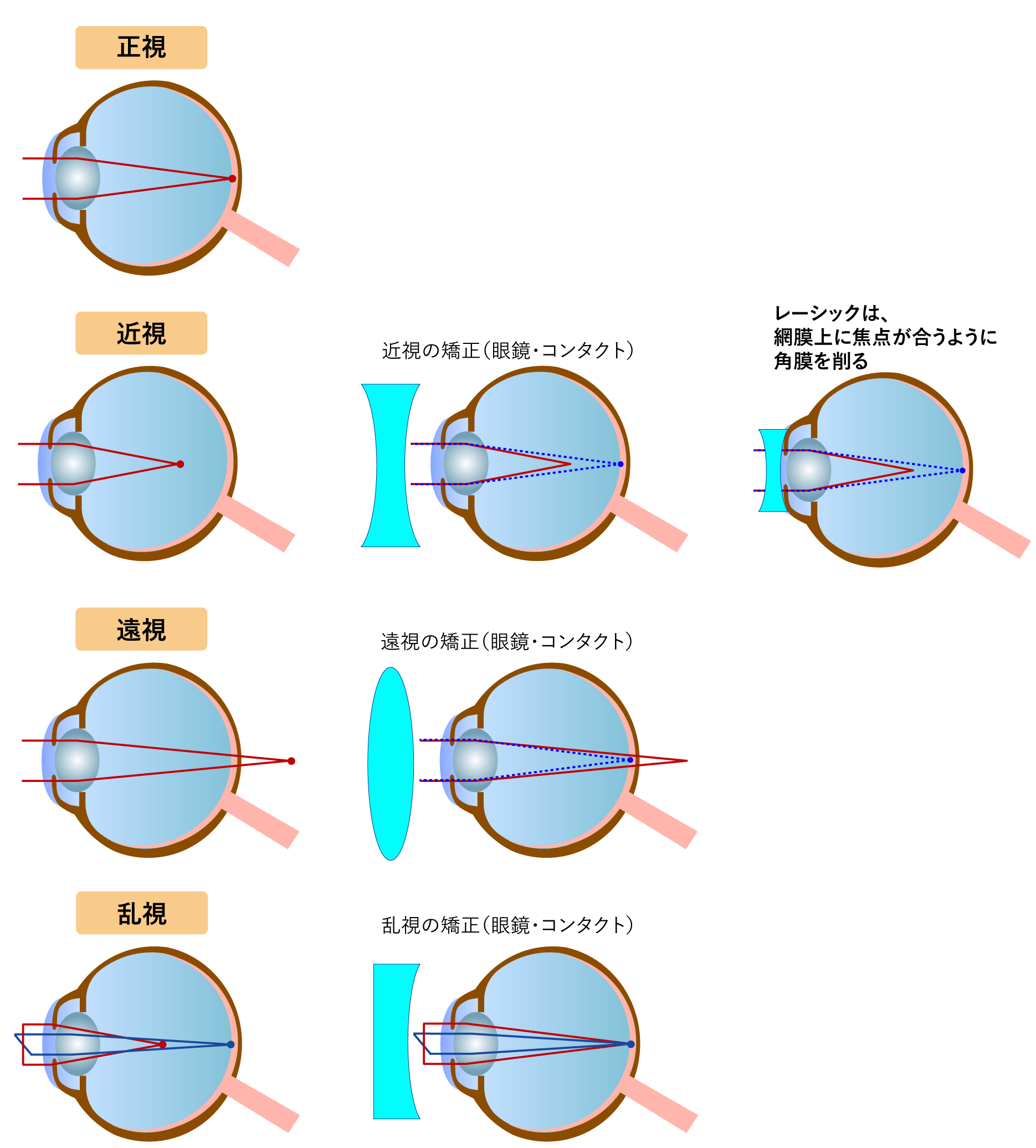 近視 遠視 乱視と老眼 老眼とレーシックの関係 横浜市戸塚 戸塚駅前鈴木眼科 白内障日帰り手術 全員無料送迎 トツカーナ5f