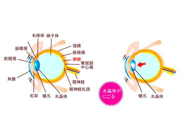 白内障　多焦点眼内レンズ