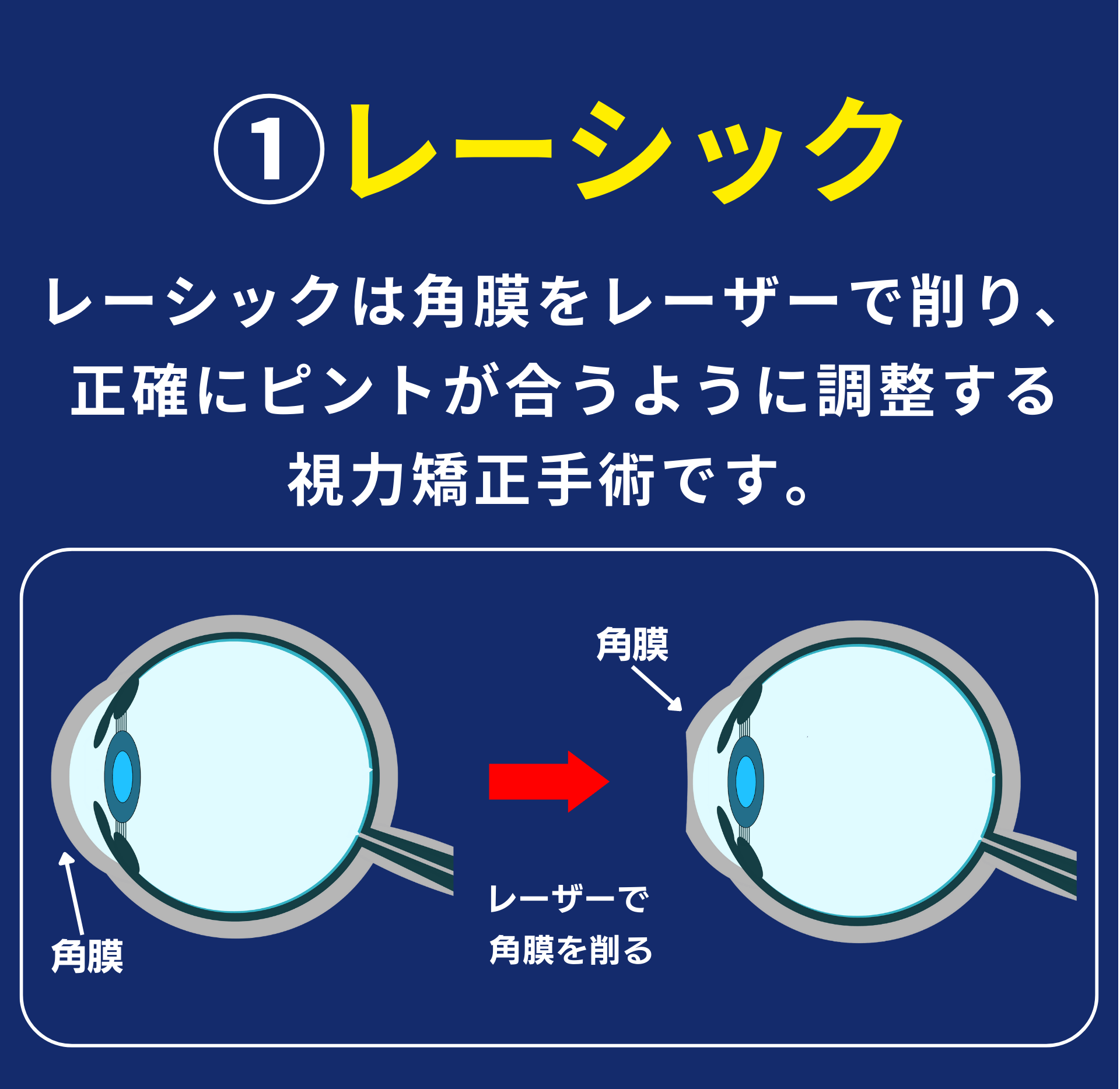 多焦点眼内レンズを知っていますか？資料請求【自費】