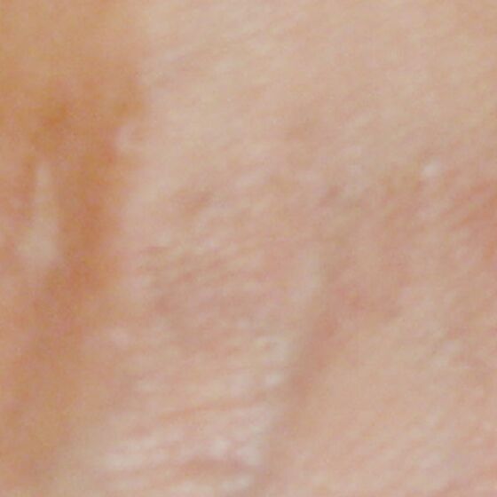 After-Picosure-3