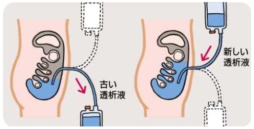 腹膜透析のイメージ