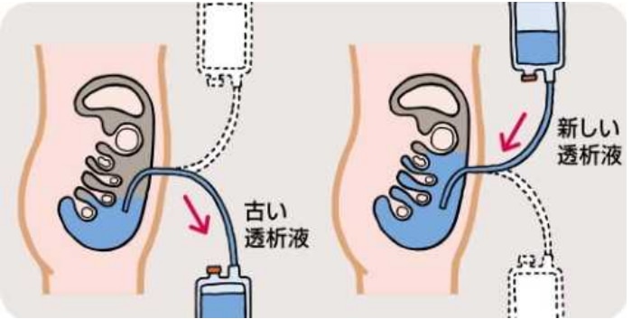 腹膜透析のイメージ