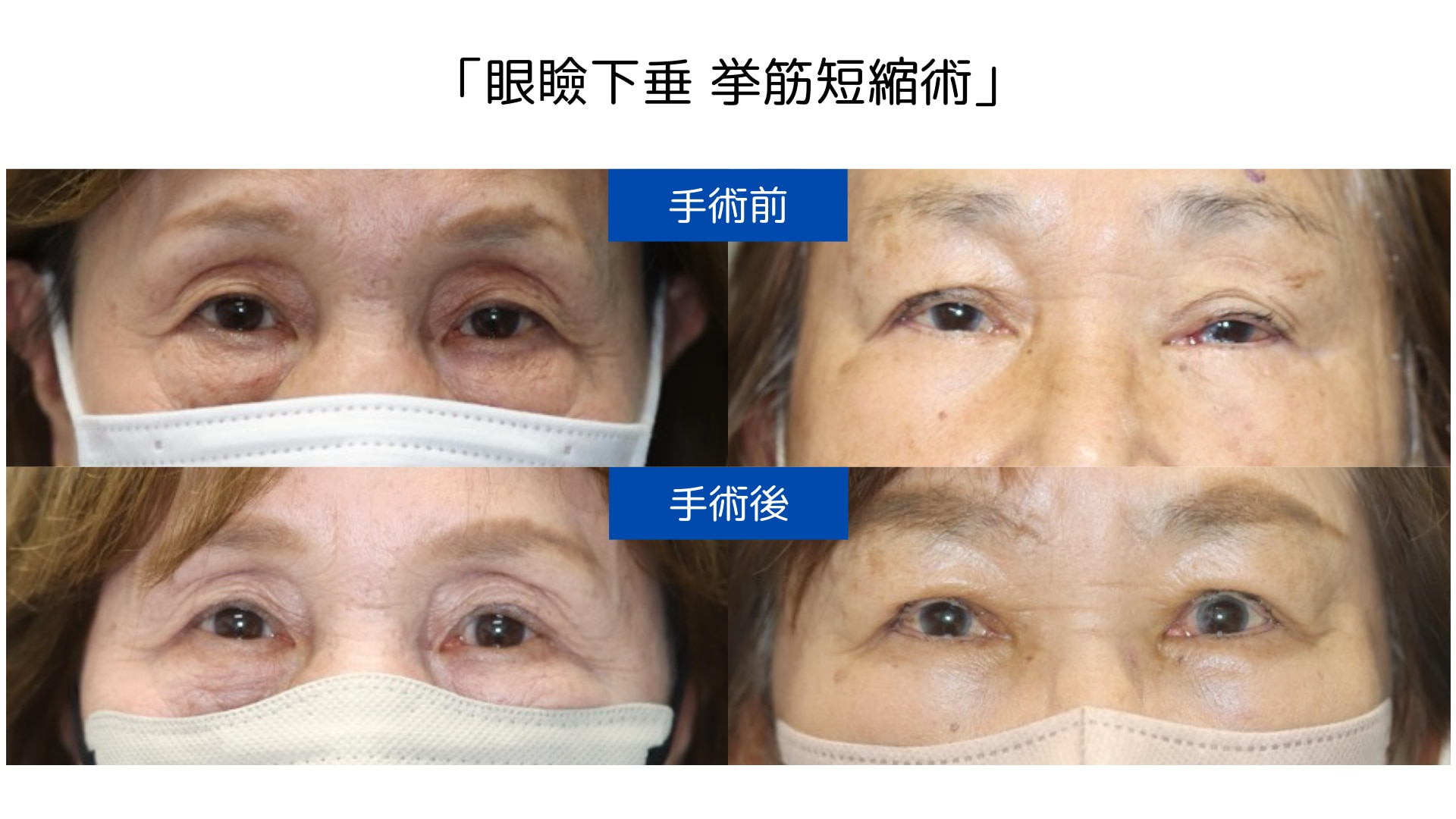 眼瞼下垂の治療