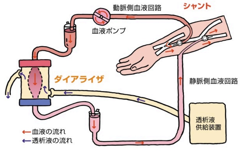 血液透析の仕組み