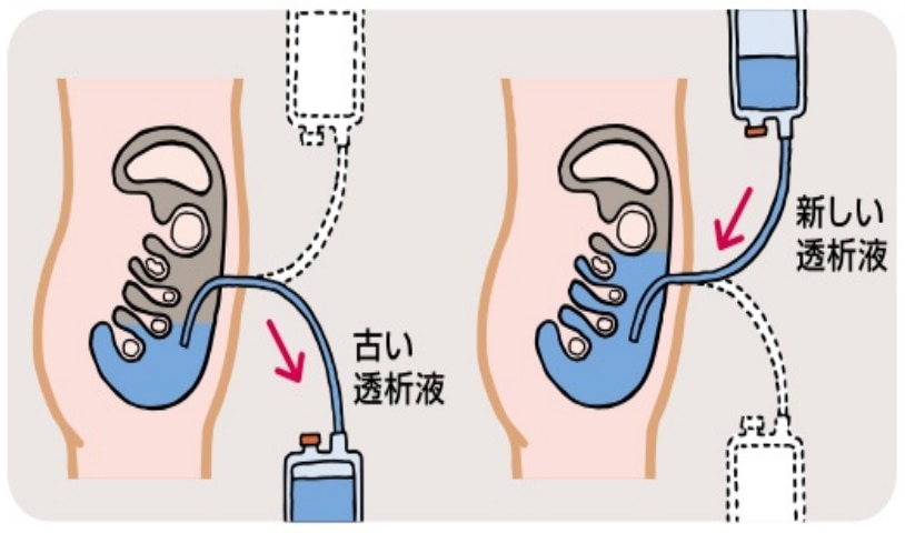 腹膜透析の仕組み