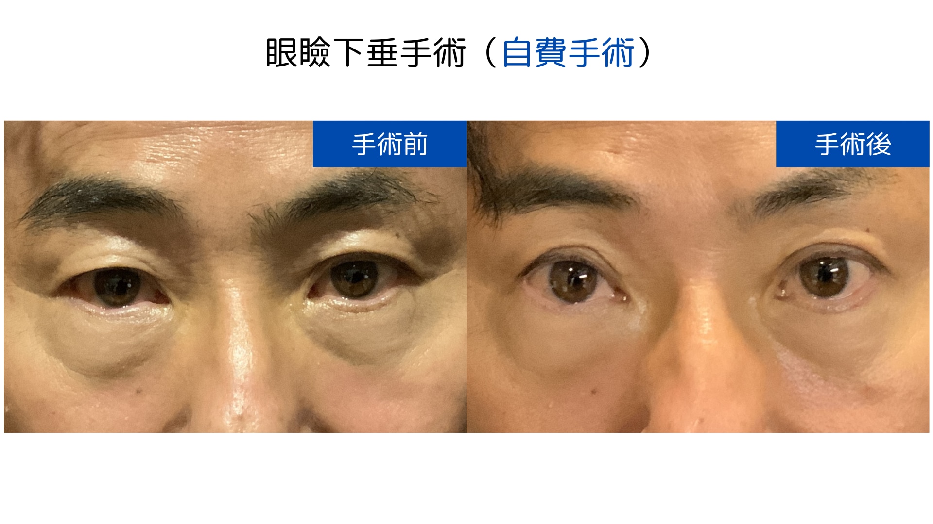 眼瞼下垂 眼形成外科医が行う眼瞼下垂手術 | 眼瞼下垂手術ならオキュロ