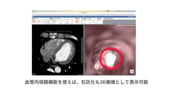 3Dビューア機能_血管内視鏡機能/気管支鏡機能