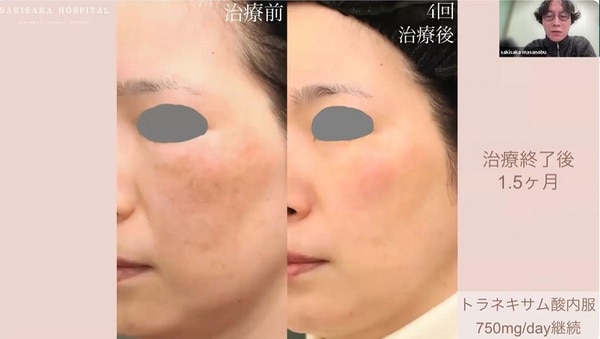 4回治療後、1.5か月のフォローアップ