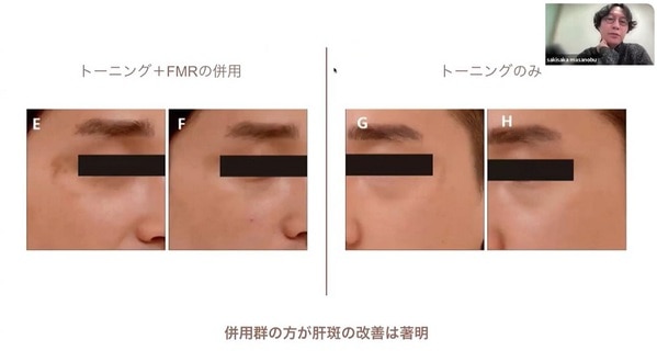 トーニング＋FMRの併用とトーニングのみの比較