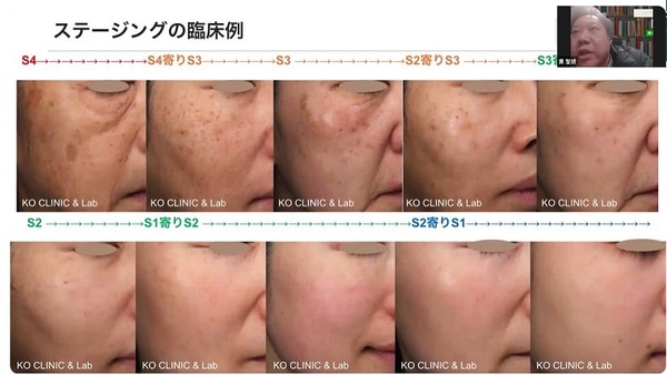ステージング臨床例
