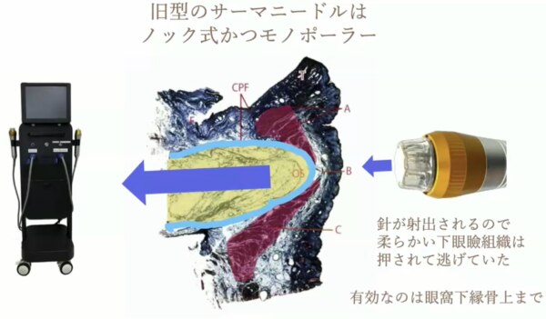 サーマニードルの課題