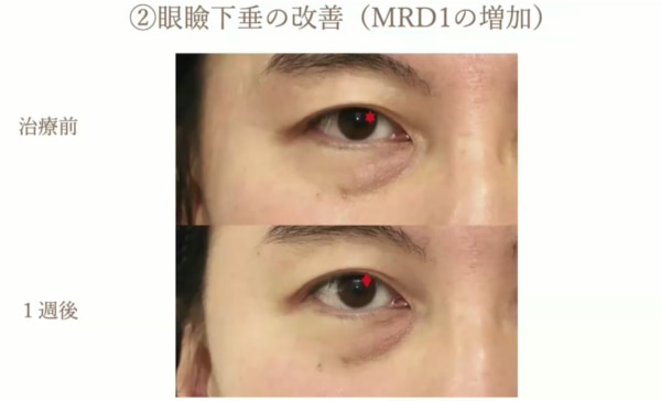 眼瞼下垂の改善