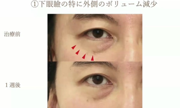 下眼瞼の特に外側のボリューム減少