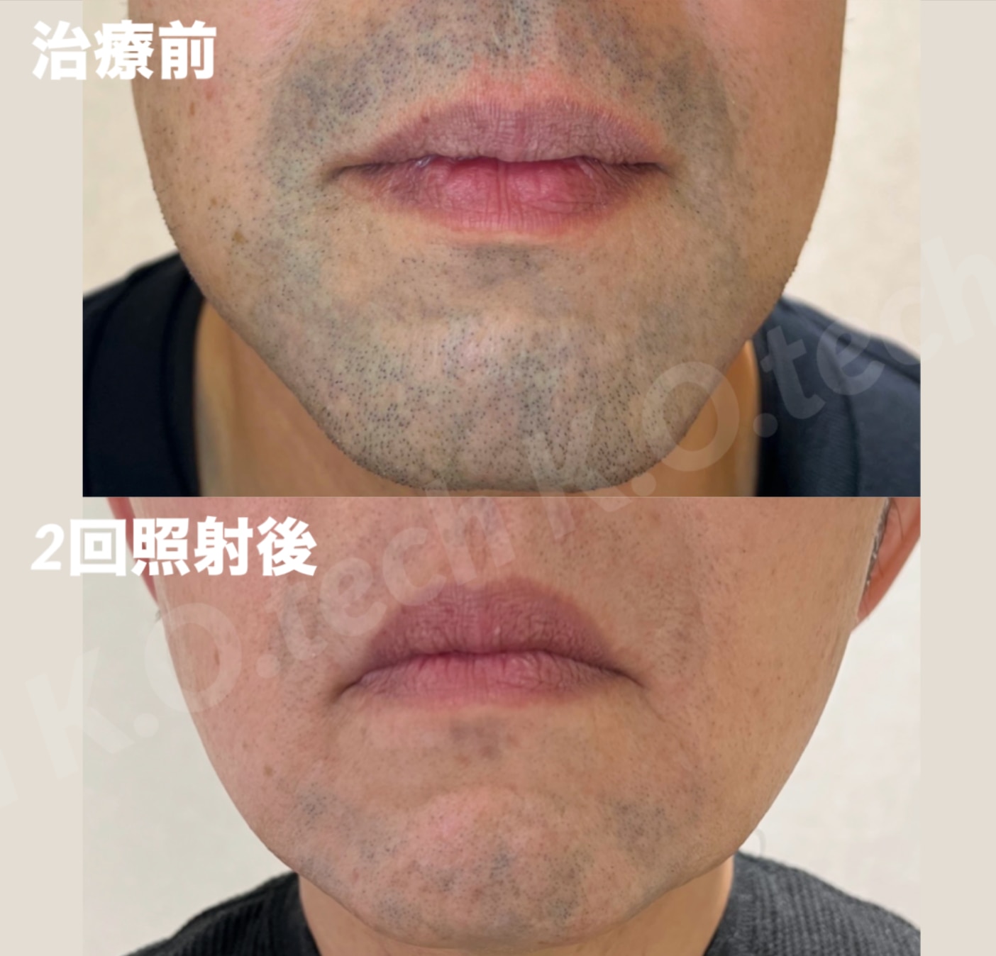 ヴィーナスワン症例写真1