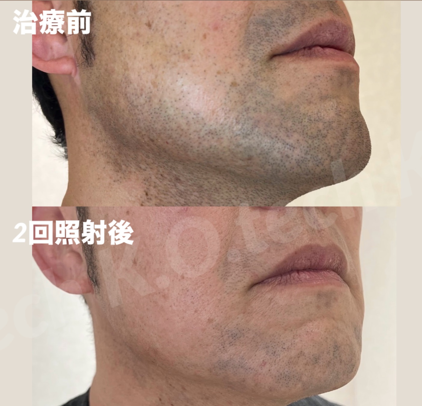 ヴィーナスワン症例写真2